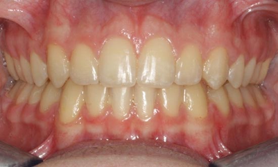 Fox Kids Dentistry and Orthodontics - Braces Before
