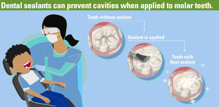 Dental Sealants and How They Help Prevent Cavities