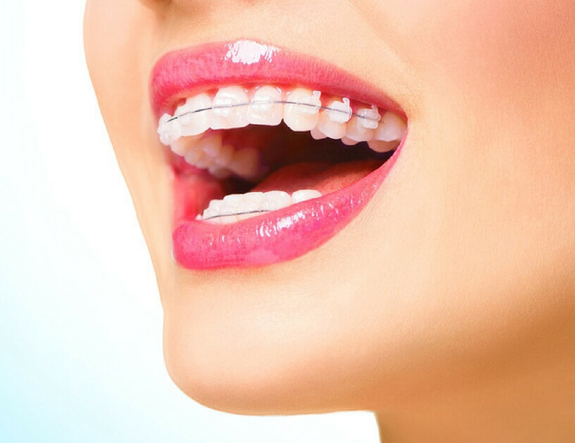 What Are Ceramic Braces?, Pros & Cons of Ceramic Braces