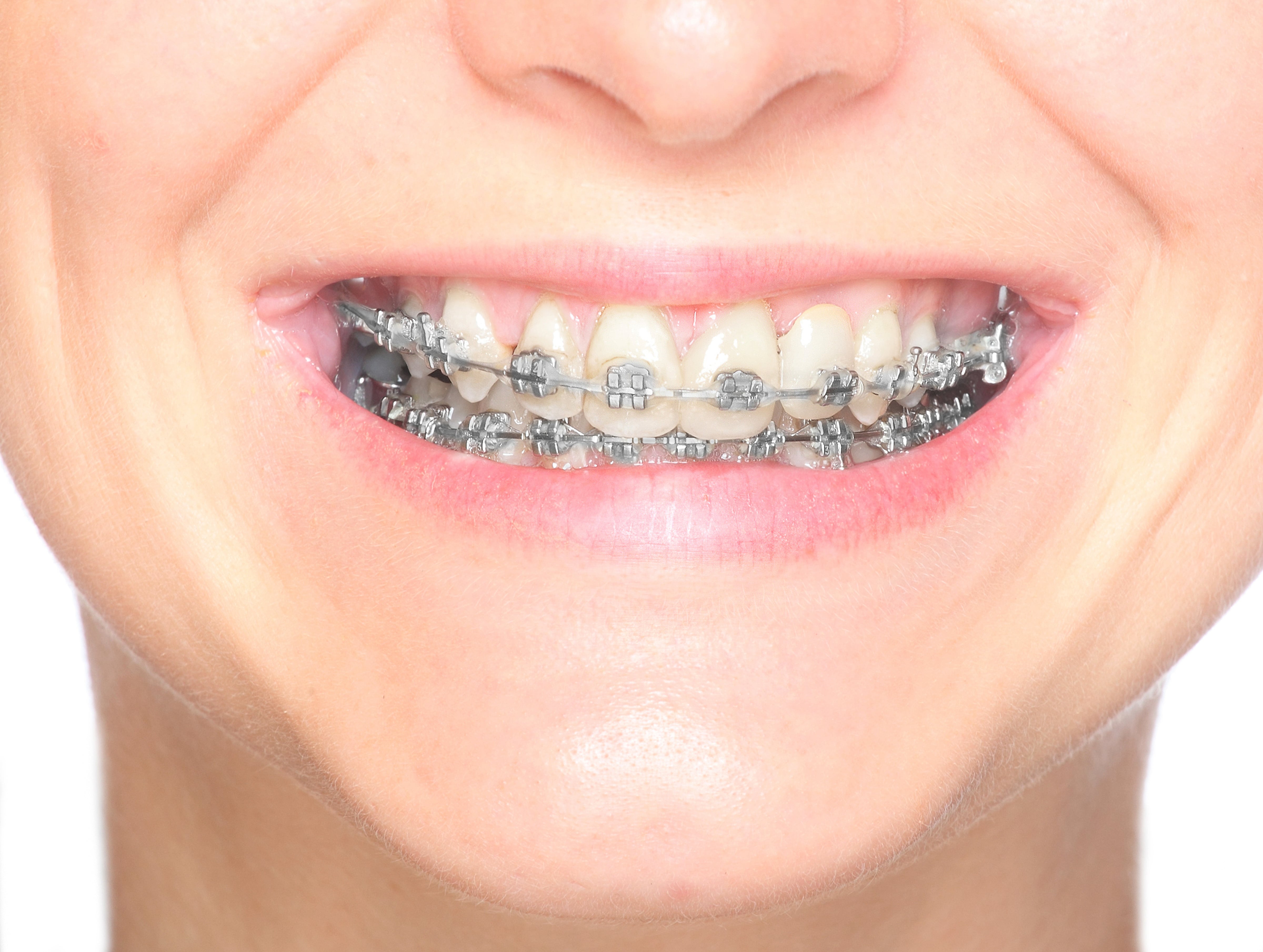 Clear Braces, Portland Orthodontist